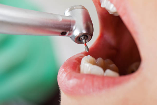 Best Emergency Wisdom Teeth Removal in East Lansing, MI